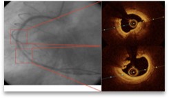 The CAOCT study